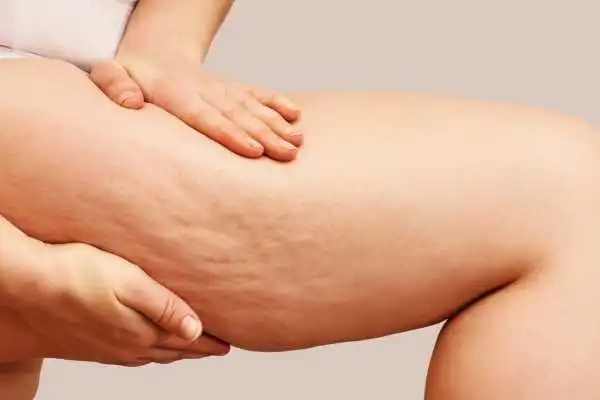 Image of woman showing leg with cellulite Harpenden