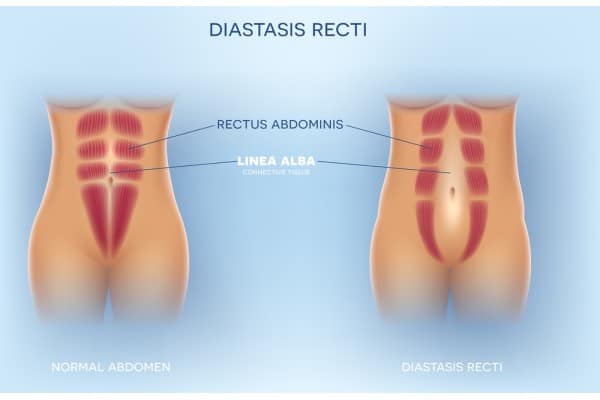 What Non-Surgical Options Are Available for Diastasis Recti Harpenden?