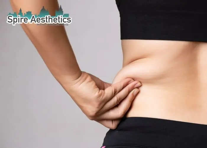 Image of woman pinching fat on their hips Harpenden. Fat Freezing treatment