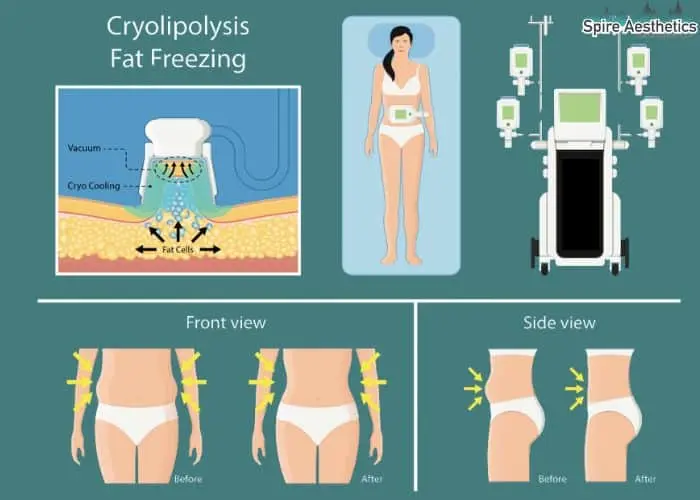 Fat freezing treatment Harpenden benefits for competitions to remove stubborn fat deposits.