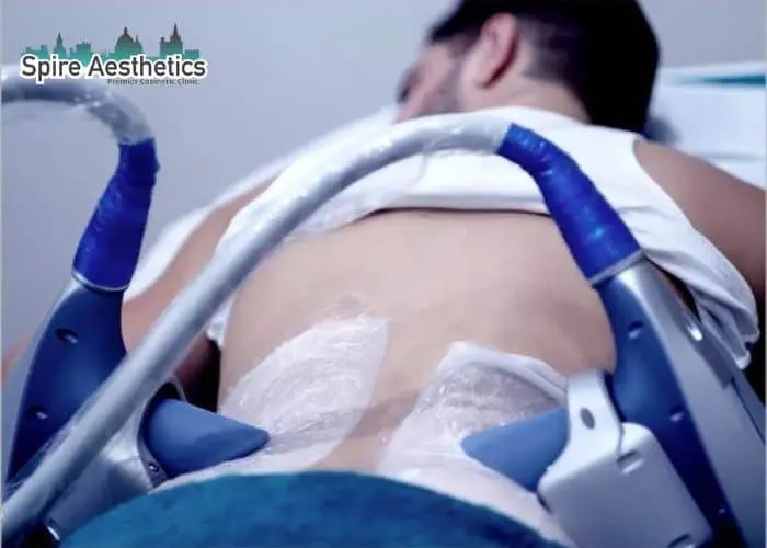 Man having fat freezing treatment done on love handles before a competitions Harpenden to create a sculpted look.