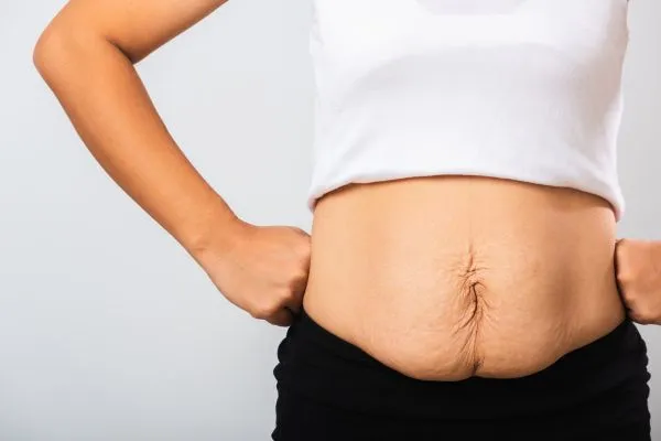 Image of a woman's stomach after weight loss with sagging skin following a gastric band Harpenden