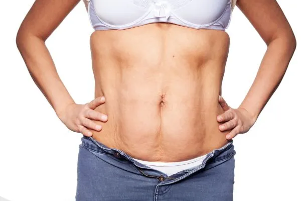 sagging skin on woman's stomach after weight loss injections Harpenden