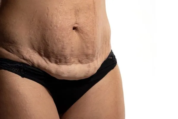 Image of womans stomach after weight loss injections Harpenden showing saggy skin