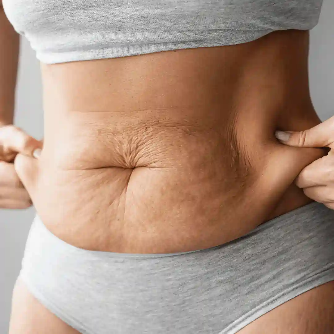 Is It Normal to Have Loose Skin After Pregnancy Harpenden?