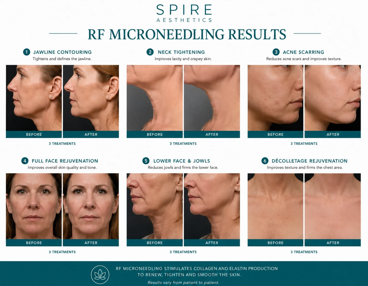 RF Microneedling Skin tightening Harpenden results
