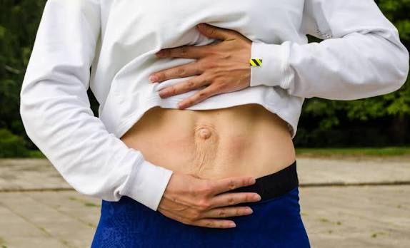 When Could Diastasis Recti Be the Missing Piece of the Puzzle Harpenden?