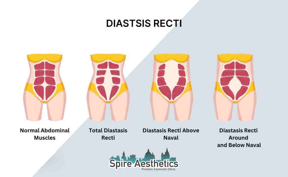 Is Non-Surgical Diastasis Recti Treatment Right for You? Common Concerns Answered Harpenden
